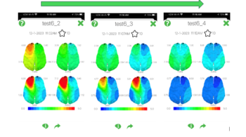 brain map before and after a direct neurofeedback session